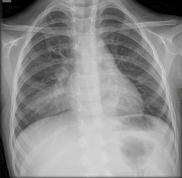 Foreign body inhalation_Table Image 5 Foreign body inhalation_Table Image 5